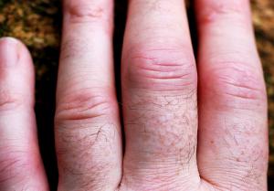 artrite infiammatoria